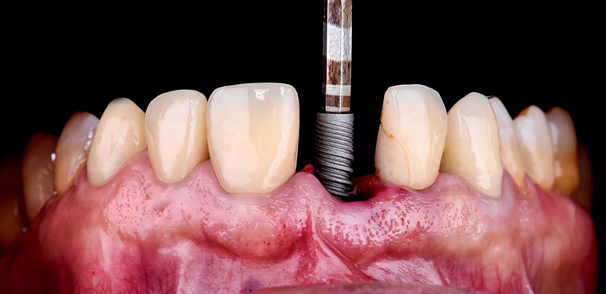 Risks associated with dental implant surgery